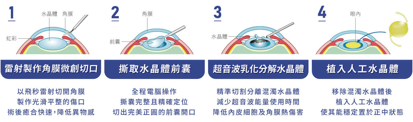 飛秒雷射白內障手術方式
